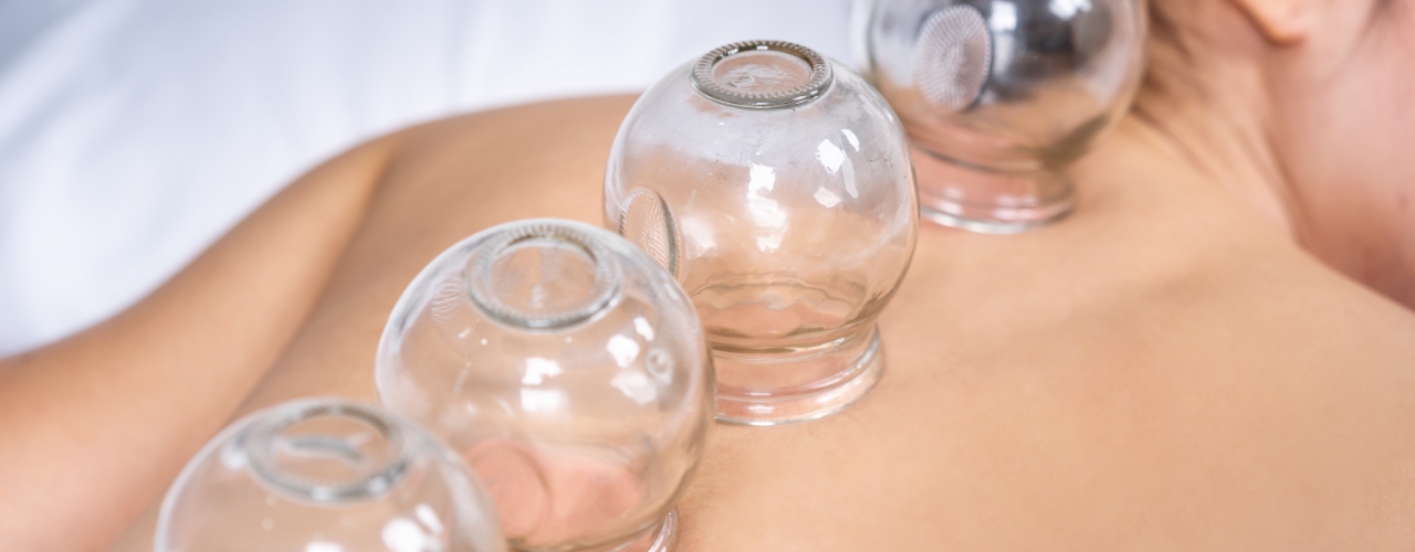 Cupping-Suburban-Physical-Therapy-Twinsburg-Brecksville-OH