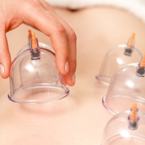 Cupping-Suburban-Physical-Therapy-Twinsburg-Brecksville-OH